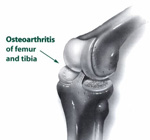 Knee with Arthritis