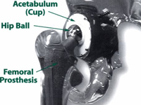 Hip after Total Hip Replacement