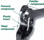 Knee after Total Knee Replacement