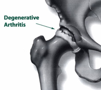 Rodilla con Artritis