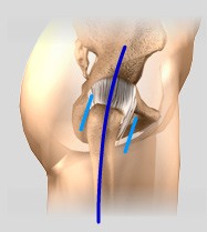 Two-Incision Approach