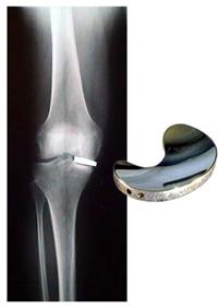 MIS Knee: Unispacer